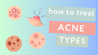 Exploring the Different Types of Acne Lesions and How to Treat Them